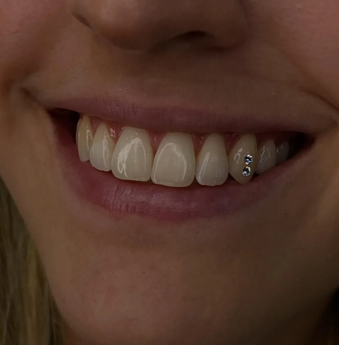 Joyería dental